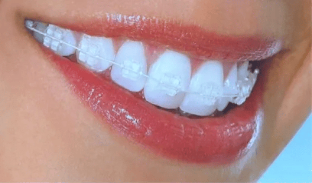 Invicible braces