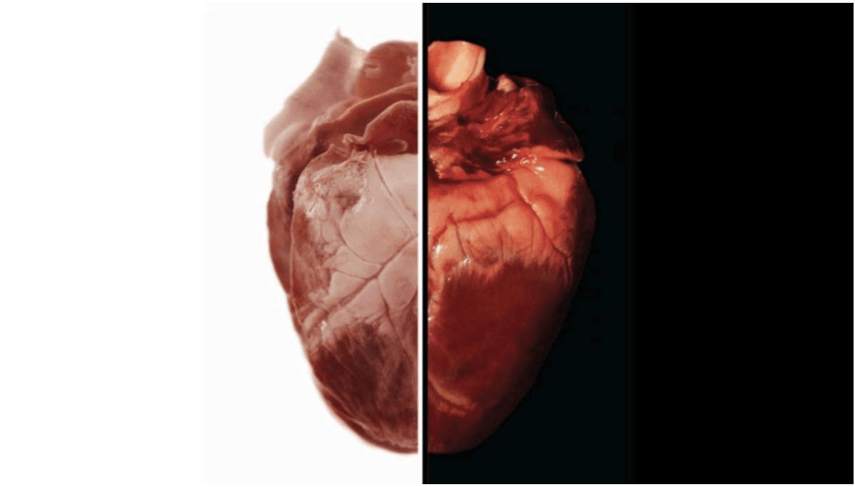 Pig-to-Human Heart Transplant