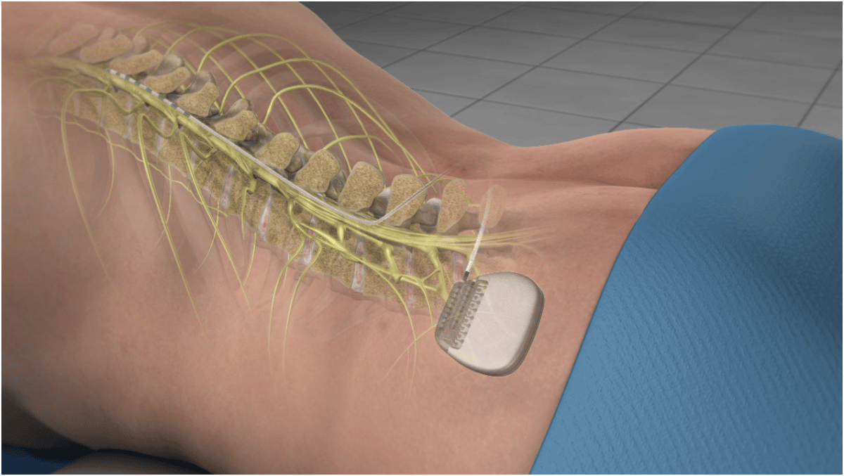 Spinal Cord Implant